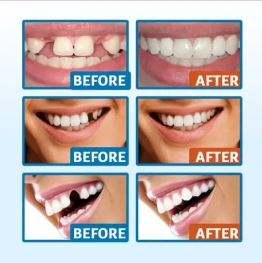 Official Store：✅ Keovp™ Temporary Moldable Tooth