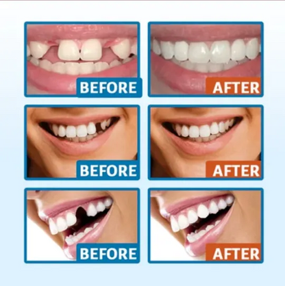 Official Store：✅ Keovp™ Temporary Moldable Tooth